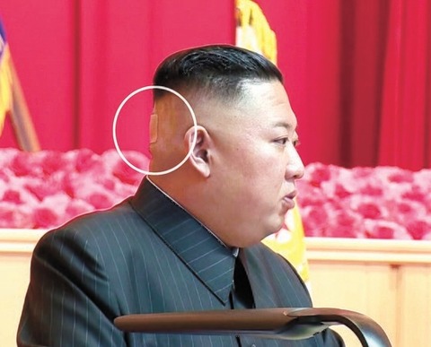 【北朝鮮】後頭部に「バンド」を貼った金正恩委員長