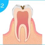 【悲報】むし歯治療に使われる詰め物がむし歯を増やしている事が判明
