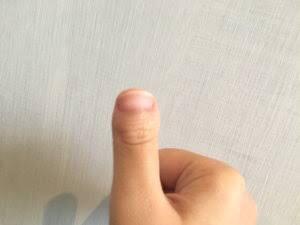【画像】親指がこの形の人、1万人に一人のレアだった