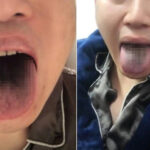 【朝鮮日報】「コロナ感染後、舌が黒くなった」「皮膚がはがれた」…新変異株の恐怖に震える中国ネット民