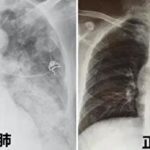 中国で強毒性変異株コロナが大流行！医者「3分の1以上が肺が線維化してX線写真が白く写る『白肺』になってる、若者が多く怖い状況」
