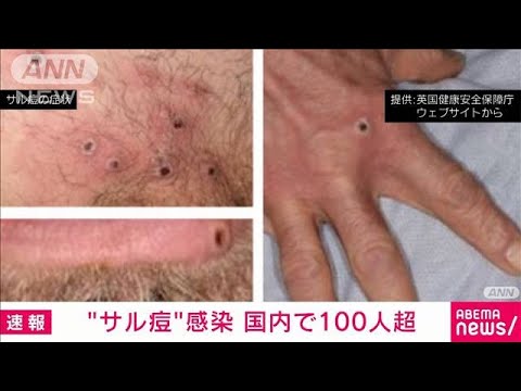【注目】西日本でも拡大‼国内感染者100人超のサル痘に注意喚起‼