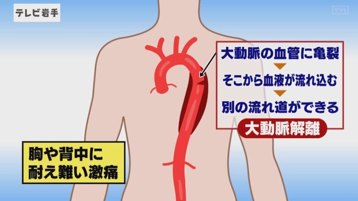 【必見】大動脈解離の恐ろさとは？突然死を防ぐための予防策を知ろう‼