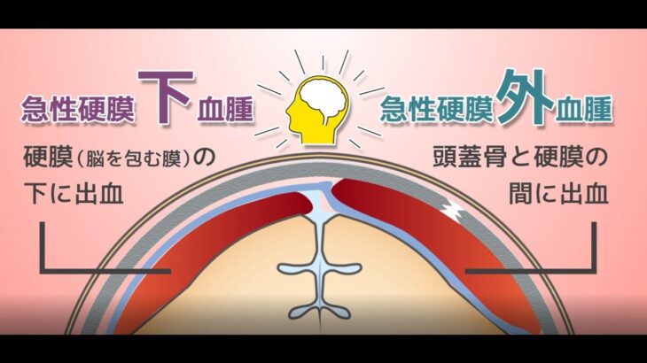 【話題】ドラゴンボール作者の死因、急性硬膜下血腫とは何か？