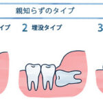 親知らずの抜歯手術で死亡事故が起きてしまう・・・