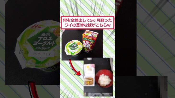 【衝撃】胃を全摘出して5ヶ月経ったワイの悲惨な飯がこちらww